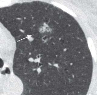 FIGURE 23.5, A 58-year-old woman, a current smoker with a 32 pack-year history. The dominant nodule (arrow) is a part solid nodule in the left upper lobe measuring 17 × 9 mm (mean diameter, 13 mm) with a solid component measuring 14 × 7 mm (mean diameter, 10 mm) (category 4B). She underwent short-interval contrast-enhanced computed tomography, and the nodule had resolved, consistent with an inflammatory nodule.