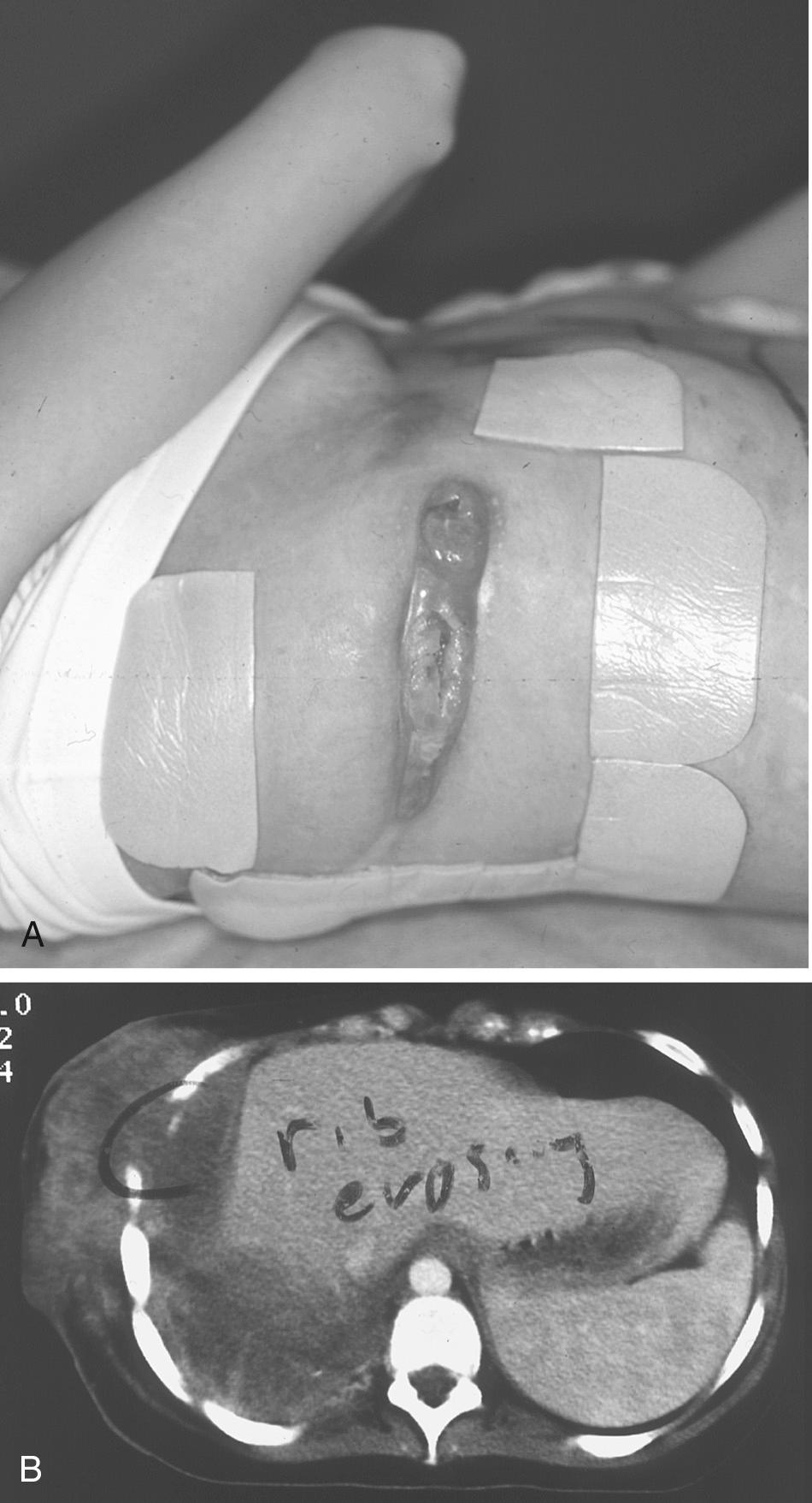 FIGURE 20-1, A, A 25-year-old woman presents to our institution with a nonhealing thoracotomy incision with a draining wound after an attempted decortication for what was initially felt to be a postpneumonic empyema. B, A CT scan demonstrates a large right lower lobe adenocarcinoma of the lung with direct invasion of the chest wall as the cause of the nonhealing wound.