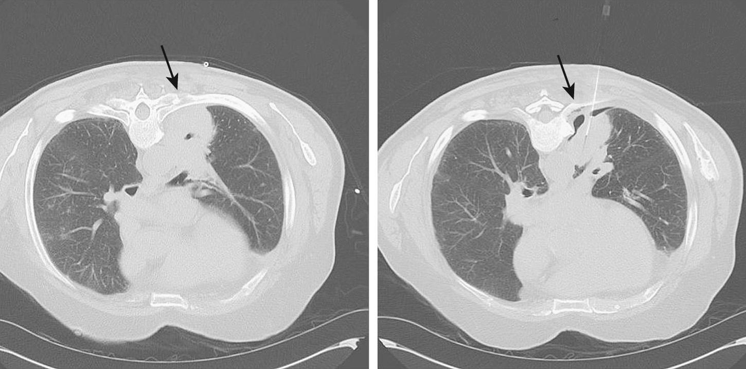 FIGURE 20-2, A CT of the chest reveals a lung mass abutting the posterior rib ( arrow in left image). A review of the images obtained during transthoracic needle biopsy showed the mass moving away from the chest wall with a minimal focal area of pneumothorax ( arrow in right image). Other images revealed complete separation from the chest wall. Note: The patient is prone in these scans for obtaining the biopsy.