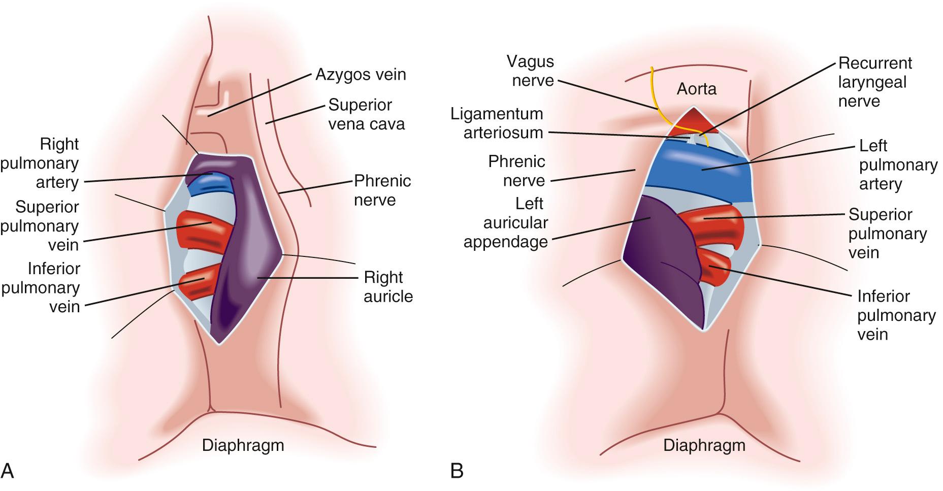 FIGURE 17-3, The anterior intrapericardial views of the right (A) and left (B) hila.