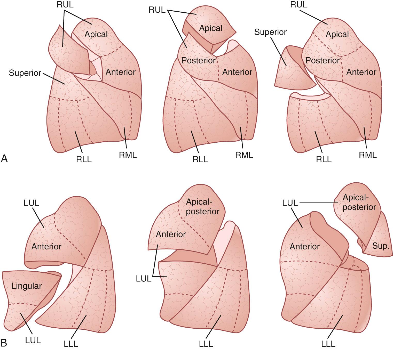 FIGURE 17-4, Segmental resections of the lung. A, Right lung. Upper lobe: posterior and apical segmentectomies. Lower lobe: superior segmentectomy. B, Left lung. Upper lobe: lingual and superior division segmentectomies. Combined segmentectomies of apical-posterior (upper lobe) and superior (Sup.) segments (lower lobe). LLL, Left lower lobe; LUL, left upper lobe; RLL, right lower lobe; RML, right middle lobe; RUL, right upper lobe.