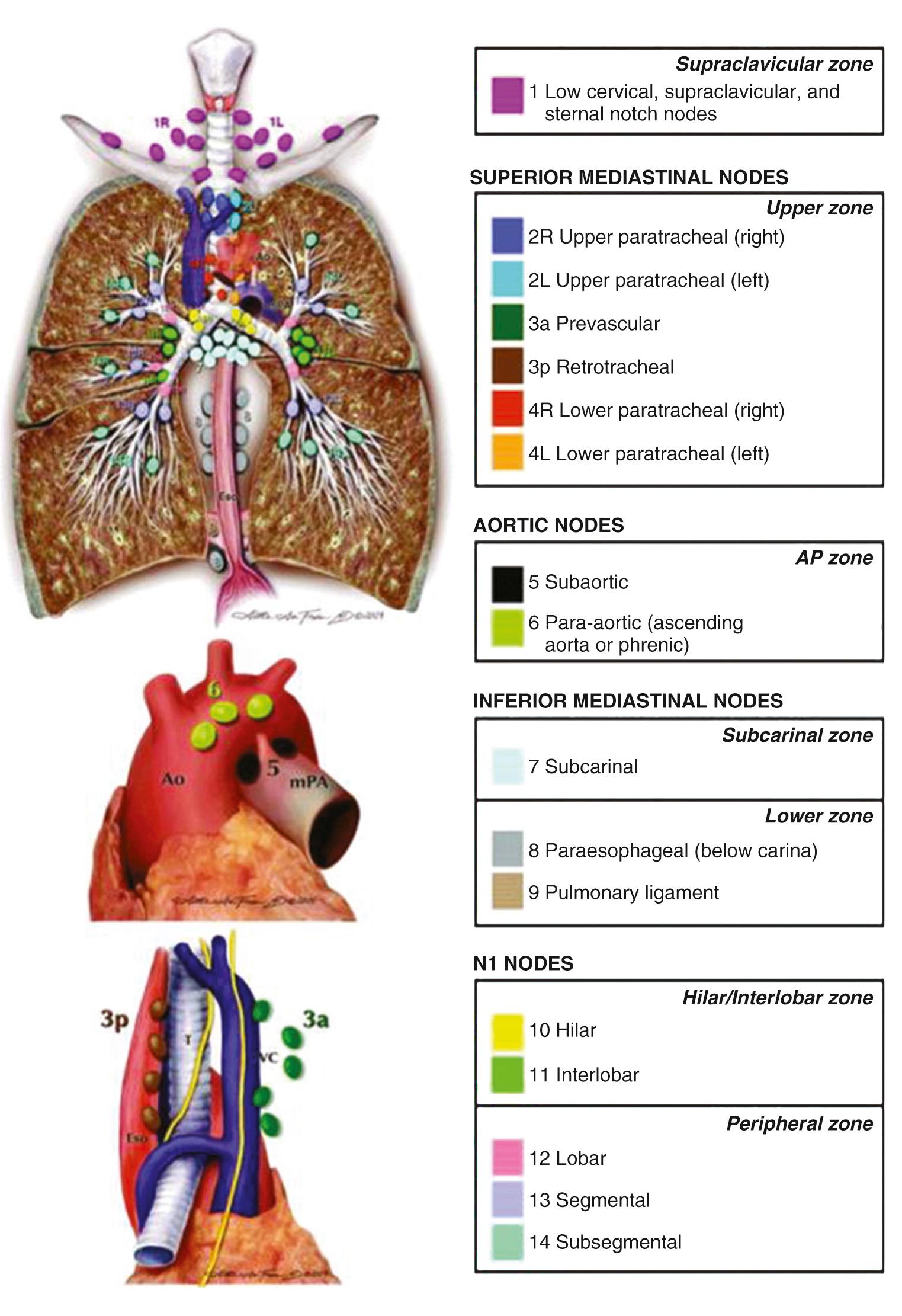 FIGURE 17-5, The International Association for the Study of Lung Cancer (IASLC) lymph node map.