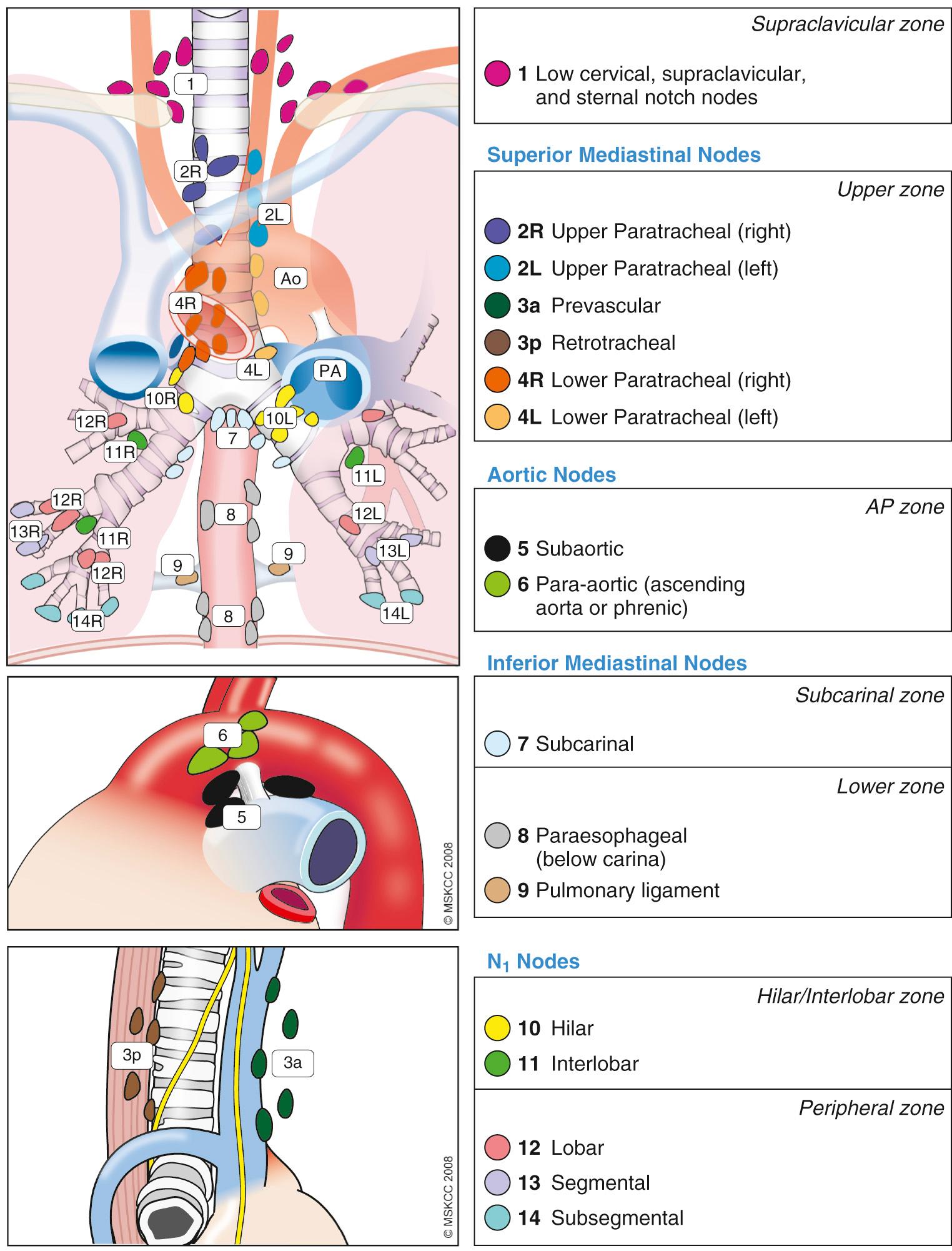 Lung Cancer Workup and Staging – Clinical Tree