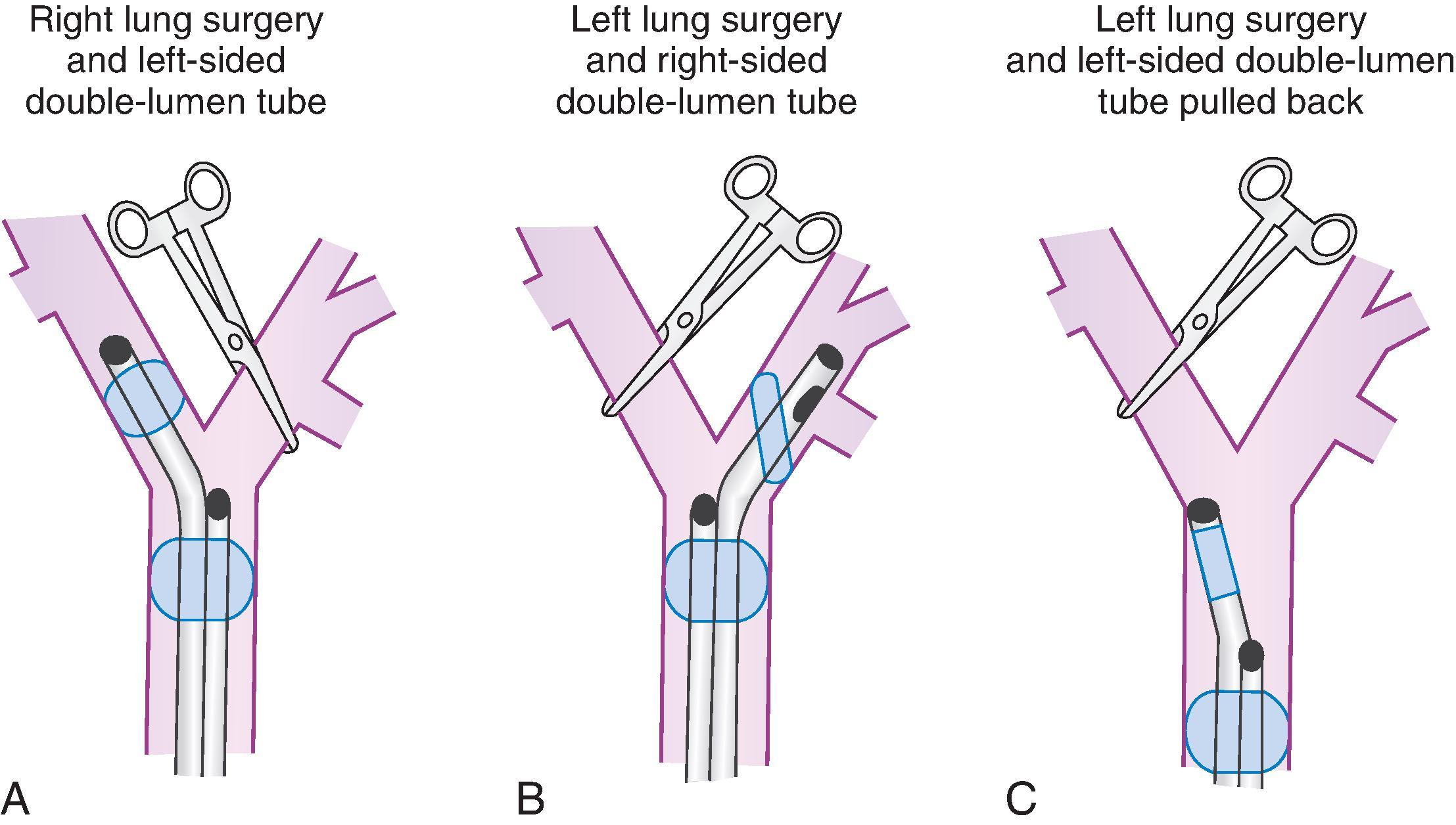 Fig. 26.2, Use of left-sided and right-sided double-lumen tubes (DLTs) for left and right lung surgery is indicated by the clamp. (A) When surgery is performed on the right lung, a left-sided DLT should be used. (B) When surgery is performed on the left lung, a right-sided DLT may be used. (C) However, because of uncertainty about the alignment of a right upper lobe ventilation slot to the right upper lobe orifice, a left-sided DLT can be used for left lung surgery. If left lung surgery requires a clamp to be placed high on the left main stem bronchus, the left endobronchial cuff should be deflated, the left-sided DLT pulled back into the trachea, and the right lung ventilated through both lumens (using the DLT as a single-lumen tube).