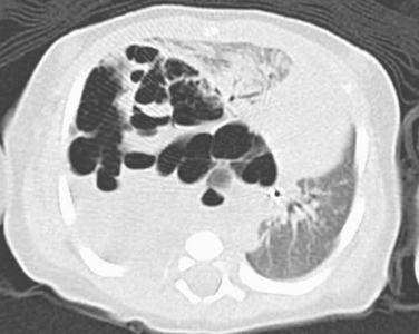 FIG. 6.1, Pleuropulmonary blastoma type I. CT image of a large multiloculated tumor in the right lower lobe of a 2-day-old infant.