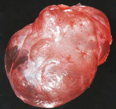 FIG. 6.2, Pleuropulmonary blastoma. Gross photograph shows an 11-cm air-filled, multiloculated tumor (right upper lobe resection).