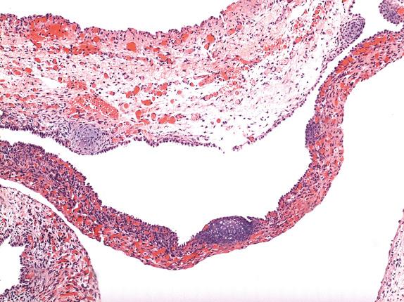 FIG. 6.5, Pleuropulmonary blastoma. Small nodules of immature cartilage are present in this cystic PPB.