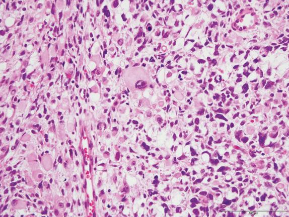 FIG. 6.6, Pleuropulmonary blastoma. PPB with solid area of rhabdomyosarcoma, including anaplasia and prominent rhabdomyoblasts.