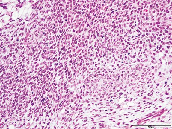 FIG. 6.7, Pleuropulmonary blastoma. Solid PPB with spindled fibrosarcoma-like differentiation.