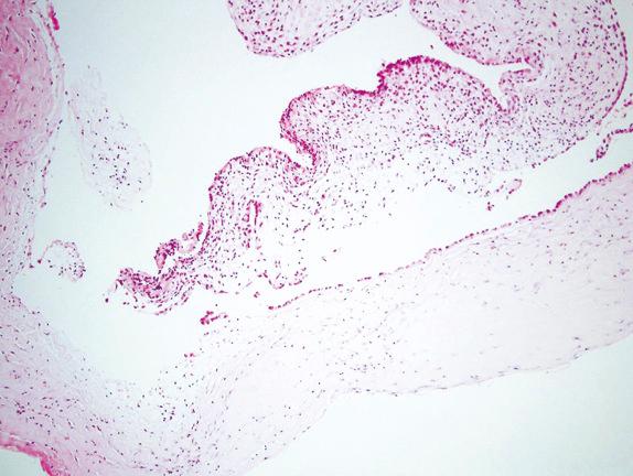 FIG. 6.9, Pleuropulmonary blastoma. This cystic PPB shows both classic type I and Ir features. The upper septum retains an indistinct subepithelial ribbon of immature mesenchymal cells (type I), whereas the lower septum is fibrotic and lacks these immature cells (type Ir).