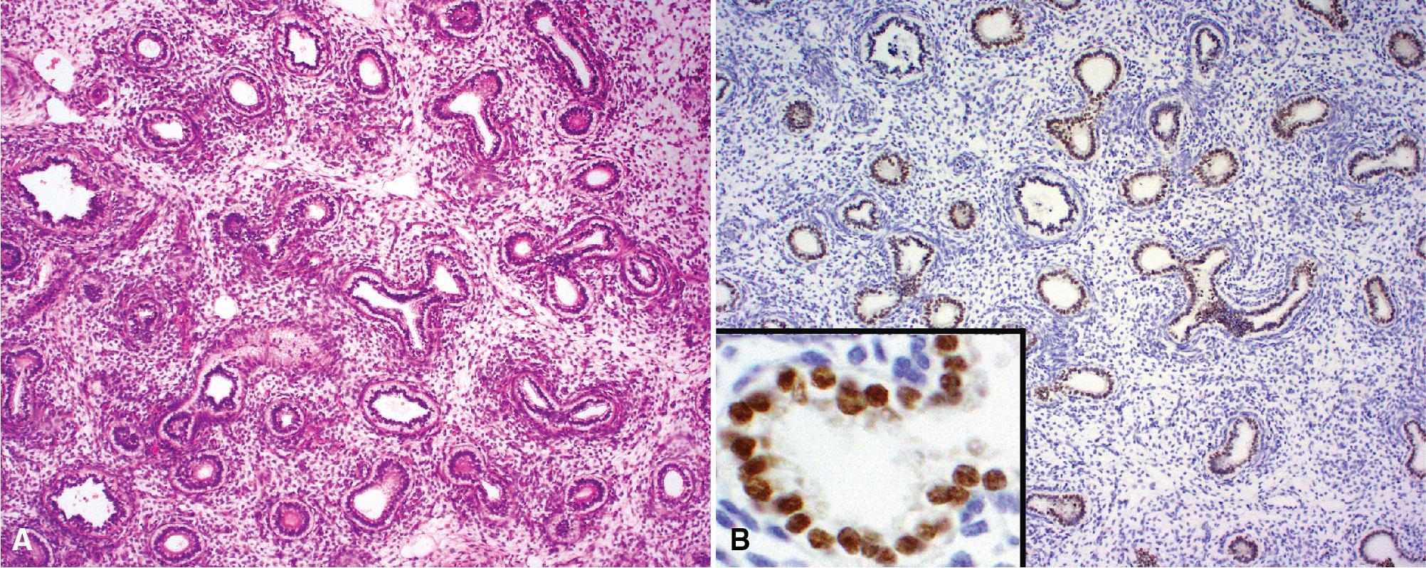 Figure 1.2, (A) In the early stage of lung development, the bronchi resemble tubular glands and are surrounded by undifferentiated mesenchyme. This stage is referred to as pseudoglandular because of this appearance (at 5–17 weeks of gestation). (B) Immunohistochemical staining for thyroid transcription factor-1 ( brown chromogen, hematoxylin counterstain) is positive in the nuclei of the immature airway cells.