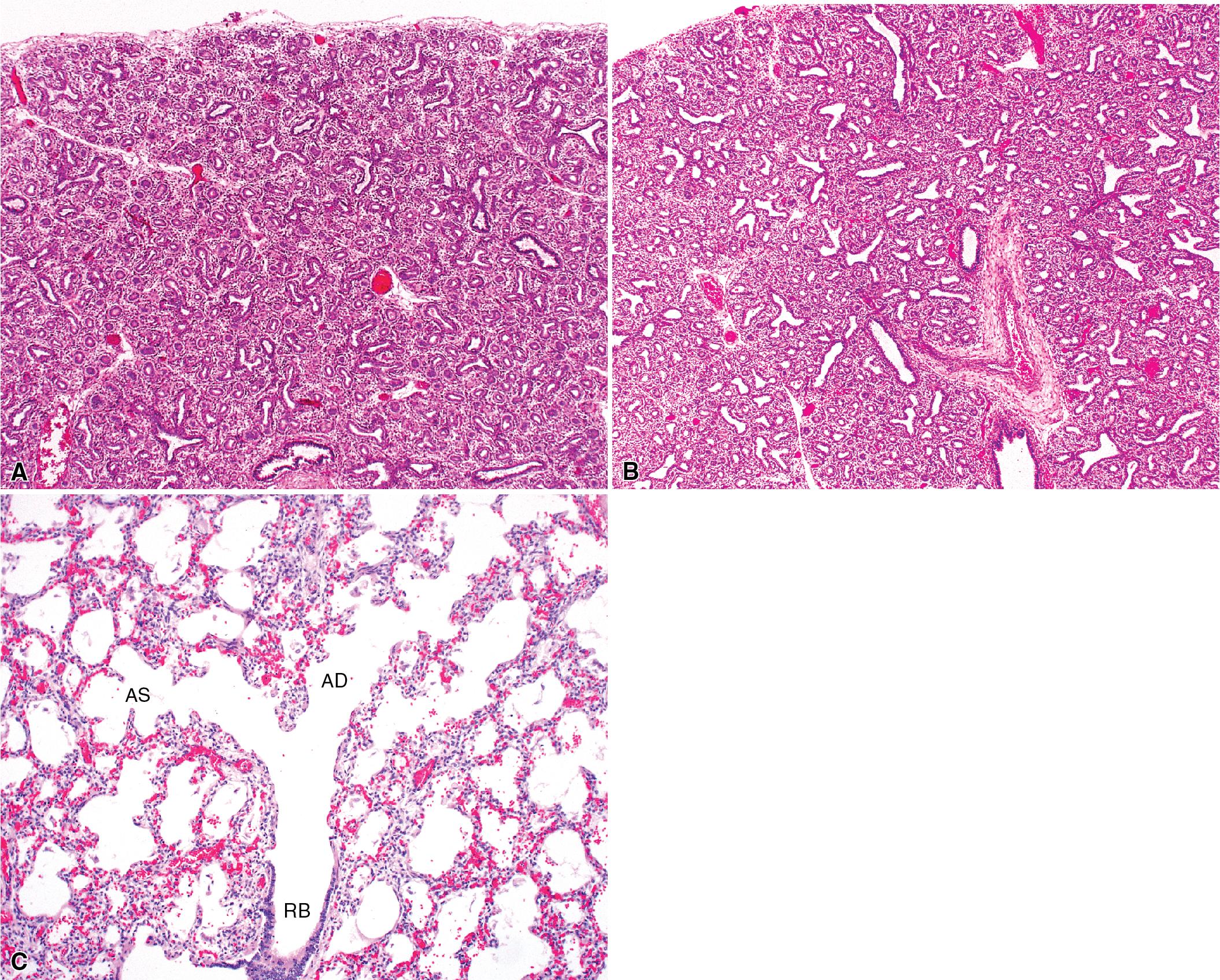 Figure 1.3, The remaining stages in lung development are illustrated here in tissue sections from developing human lung. (A) The canalicular period occurs in the interval between 13 and 25 weeks after fertilization. Airway lumens become dilated and more prominent, and the mesenchymal tissue surrounding them becomes progressively vascularized. (B) The terminal sac period occurs from 24 weeks to birth. The terminal buds of the airways at this juncture are referred to as primitive alveoli . (C) The final phase of lung development is referred to as the alveolar period and crosses into childhood (extending from the late fetal stage to 10 years of age). New alveoli continue to form well after birth. AD , Alveolar duct; AS , alveolar sac; RB , respiratory bronchiole.