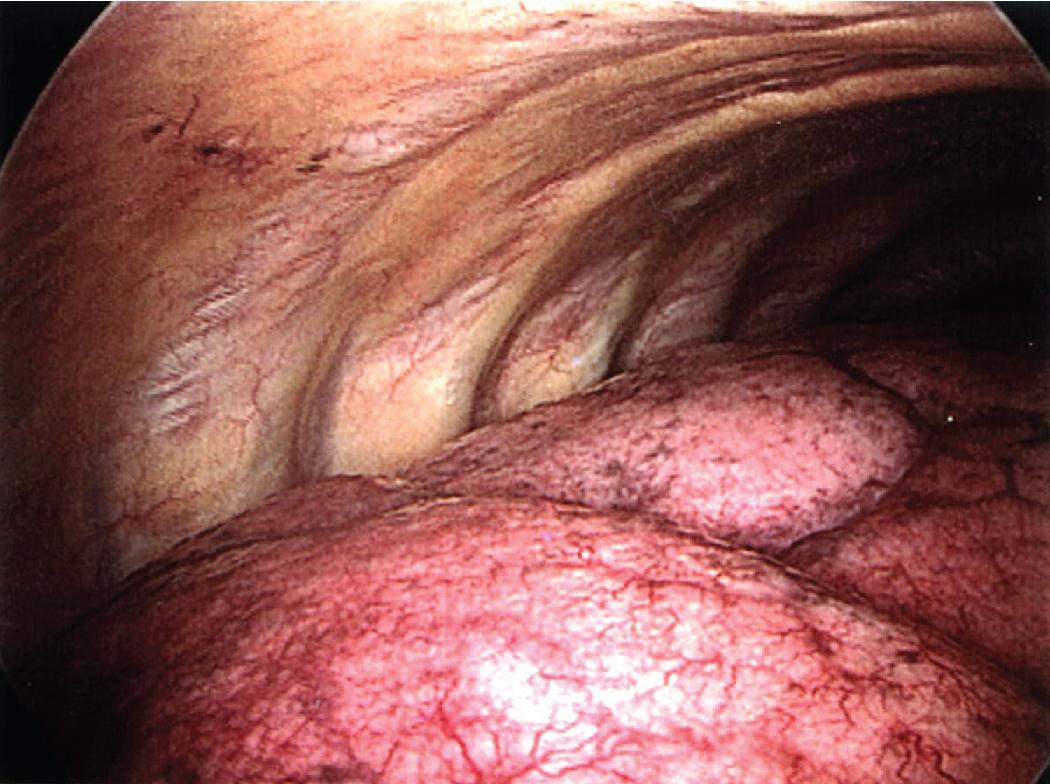 Figure 1.5, View of the collapsed lung during thoracoscopic surgery demonstrates the visceral and parietal pleural surfaces.