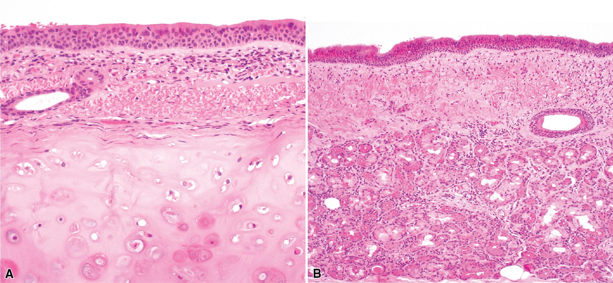 Figure 1.9, (A) The tracheal mucosa is closely applied to the anterior cartilaginous portion, with scant subepithelial tissue. (B) Posteriorly, cartilage is absent, tracheal glands are abundant, and muscle is prominent.