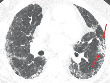 Figure 41.1, Primary bronchogenic carcinoma, pretransplantation. A patient with idiopathic pulmonary fibrosis underwent bilateral lung transplantation. Pathology of the explant revealed a mucinous lung adenocarcinoma that retrospectively was present (arrows), but closely resembles lung fibrosis.