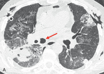 Figure 41.2, Breakdown of bronchial anastomosis. Axial (A) and coronal minimum intensity projection (B) CT images show an extraluminal collection of air adjacent to the right main bronchial anastomosis (arrows) 1 month after transplantation. Bronchoscopy confirmed an anastomotic dehiscence.