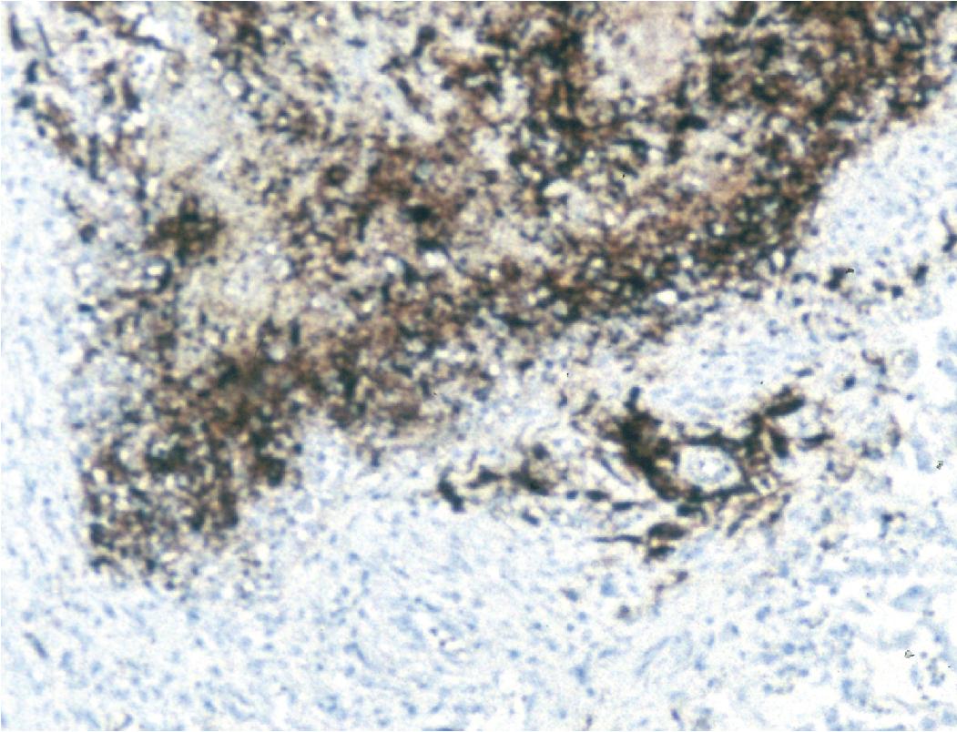 Figure 7.11, Herpes simplex virus necrotizing pneumonitis (immunohistochemical stain).