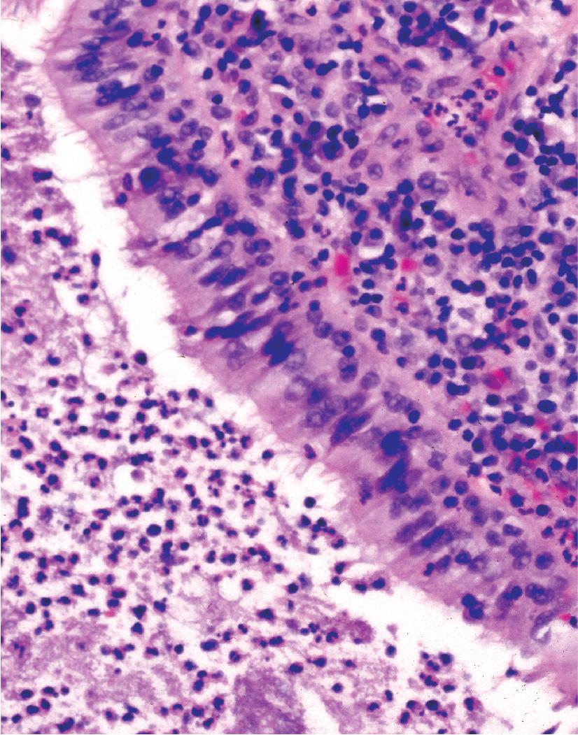 Figure 7.13, Acute and chronic bronchiolitis with intraluminal exudate.