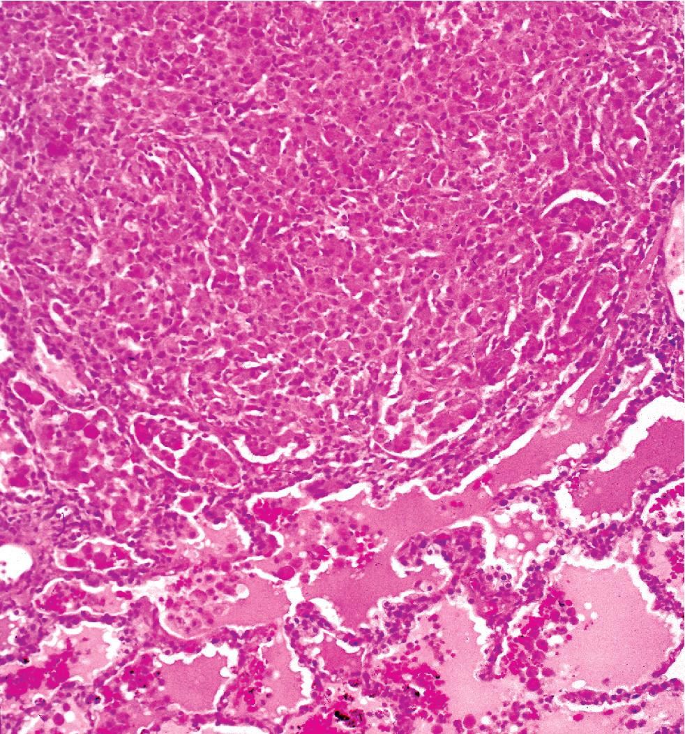 Figure 7.14, Nodular histiocytic infiltrate in rhodococcal pneumonia.