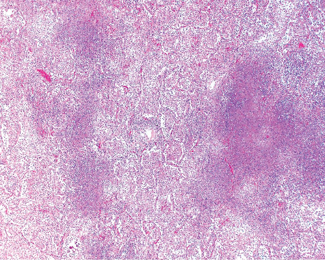 Figure 7.16, Necrotizing pneumonia, miliary pattern.