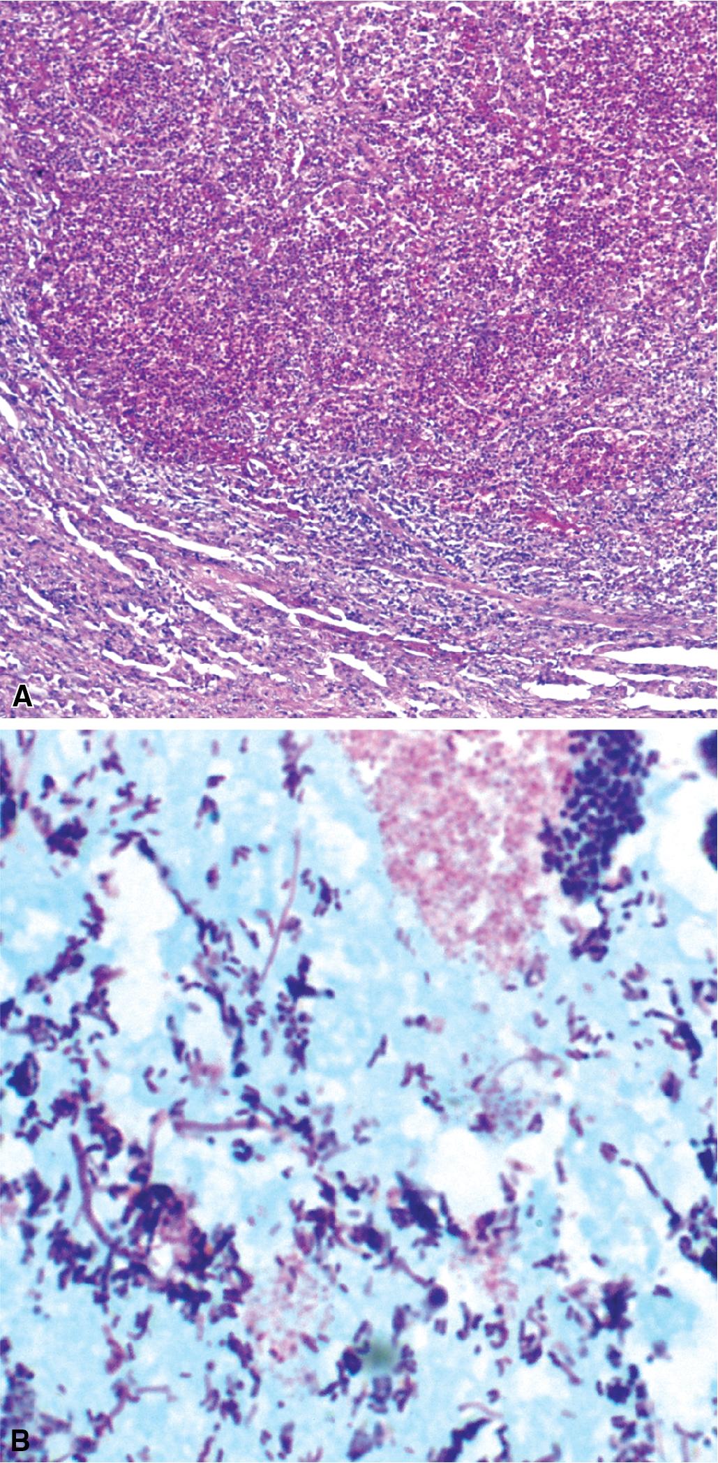 Figure 7.18, (A and B) Lung abscess with polymicrobial bacterial population (Gram stain).