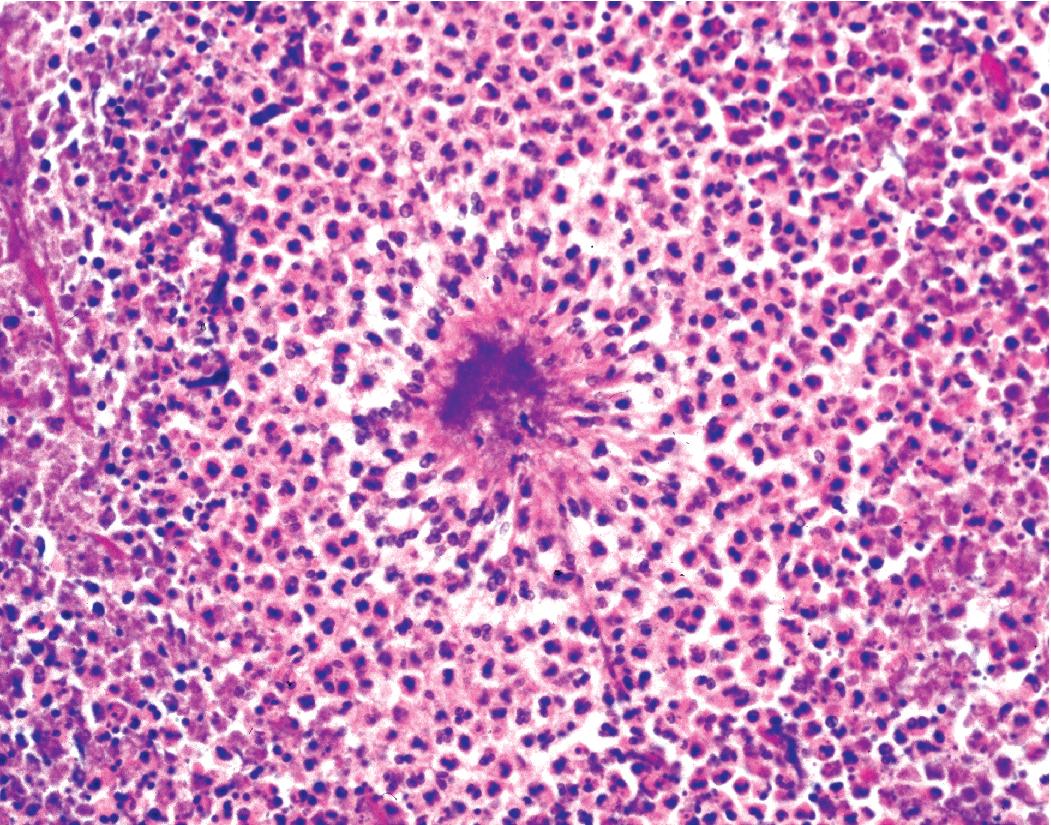 Figure 7.19, Lung abscess with sulfur granule of actinomycosis in purulent exudate.