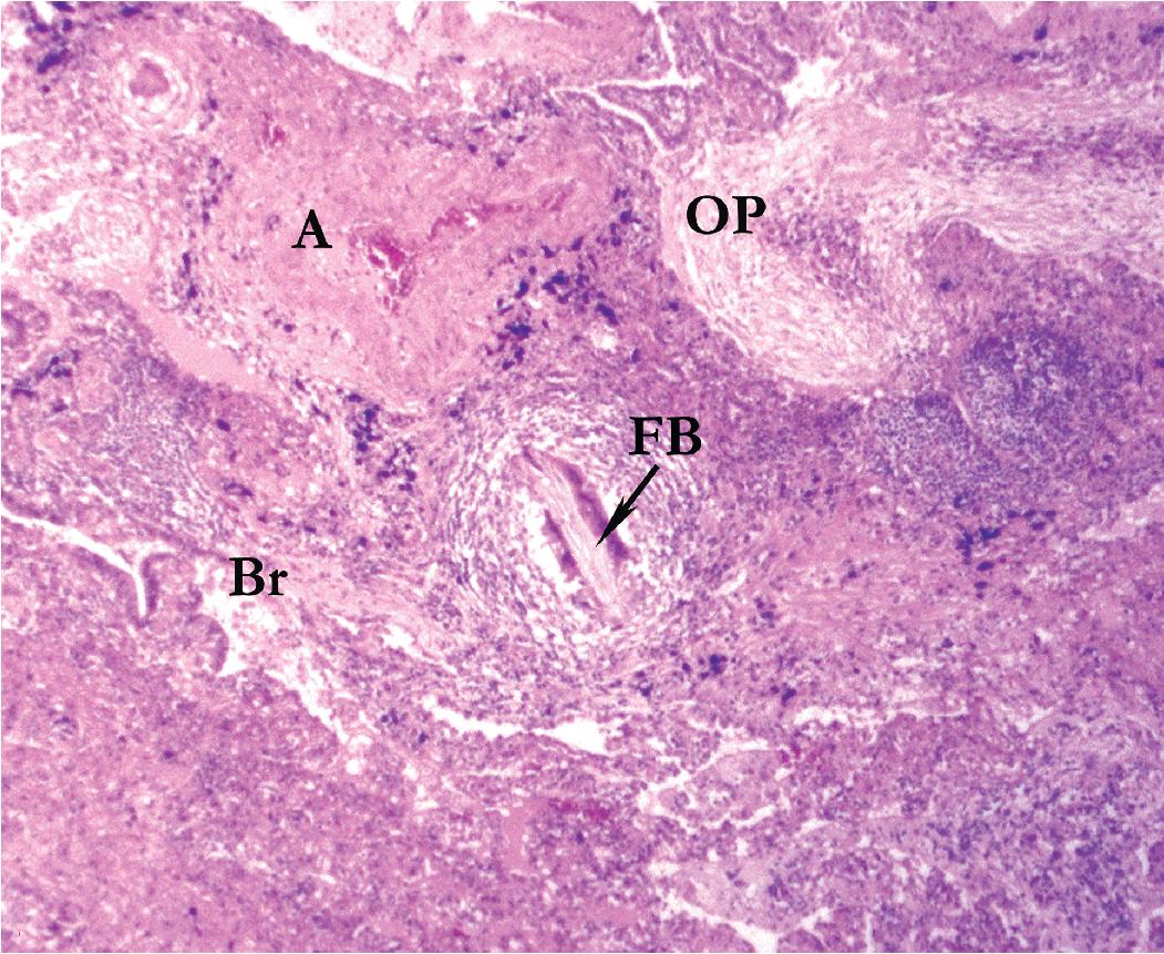 Figure 7.20, Aspiration pneumonia. Giant cells surround vegetable matter (FB) in purulent exudates, organizing pneumonia (OP) , bronchiolitis (Br) , artery (A) .