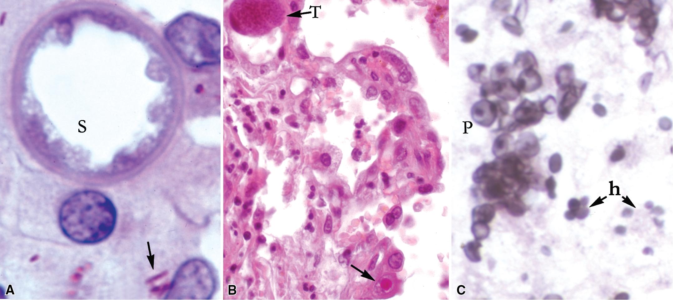 Figure 7.2, Co-infection with dual pulmonary pathogens. (A) Spherule of Coccidioides (S) and Mycobacterium avium complex acid-fast bacilli (Ziehl–Neelsen/Hematoxylin and eosin stains). (B) Toxoplasma pseudocysts (T) and cytomegalovirus-infected alveolar lining cell (arrow) . (C) Clusters of Pneumocystis cysts (P) in the midst of Histoplasma capsulatum yeast cells (h) (Grocott methenamine silver stain).