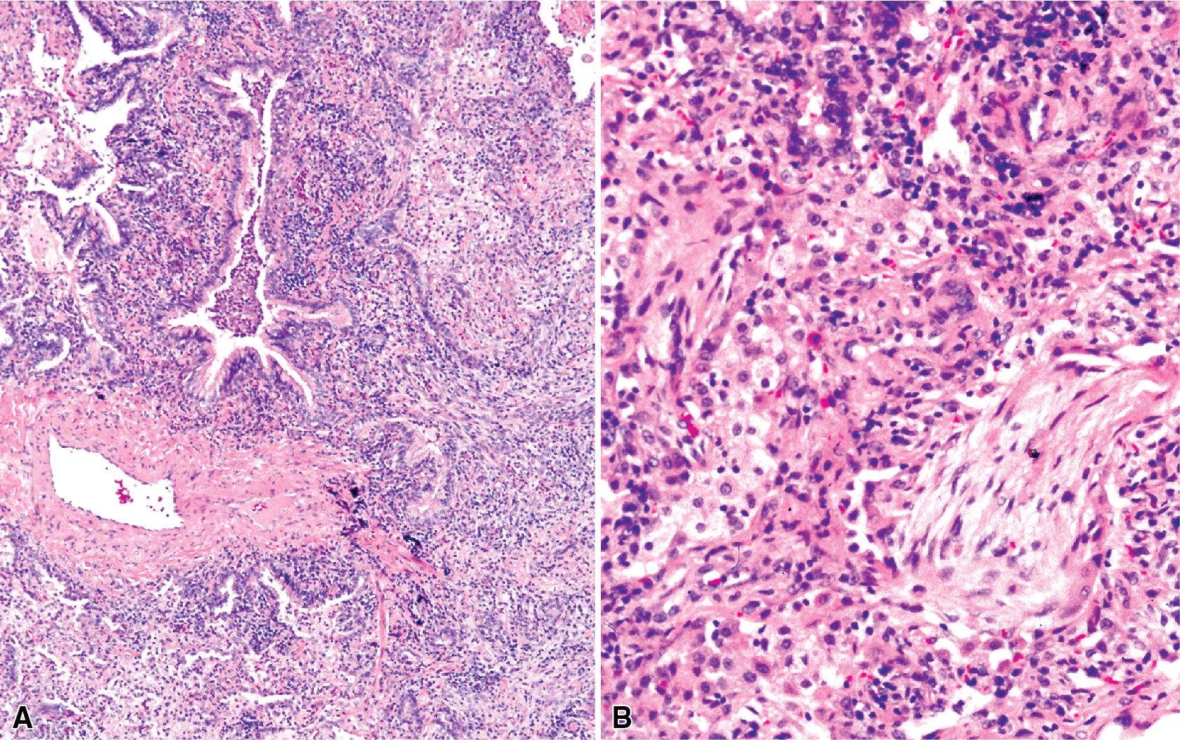 Figure 7.21, Chronic pneumonia. (A) Lymphoplasmacytic infiltrate. (B) Fascicles of fibroblasts in alveolar ducts and spaces.