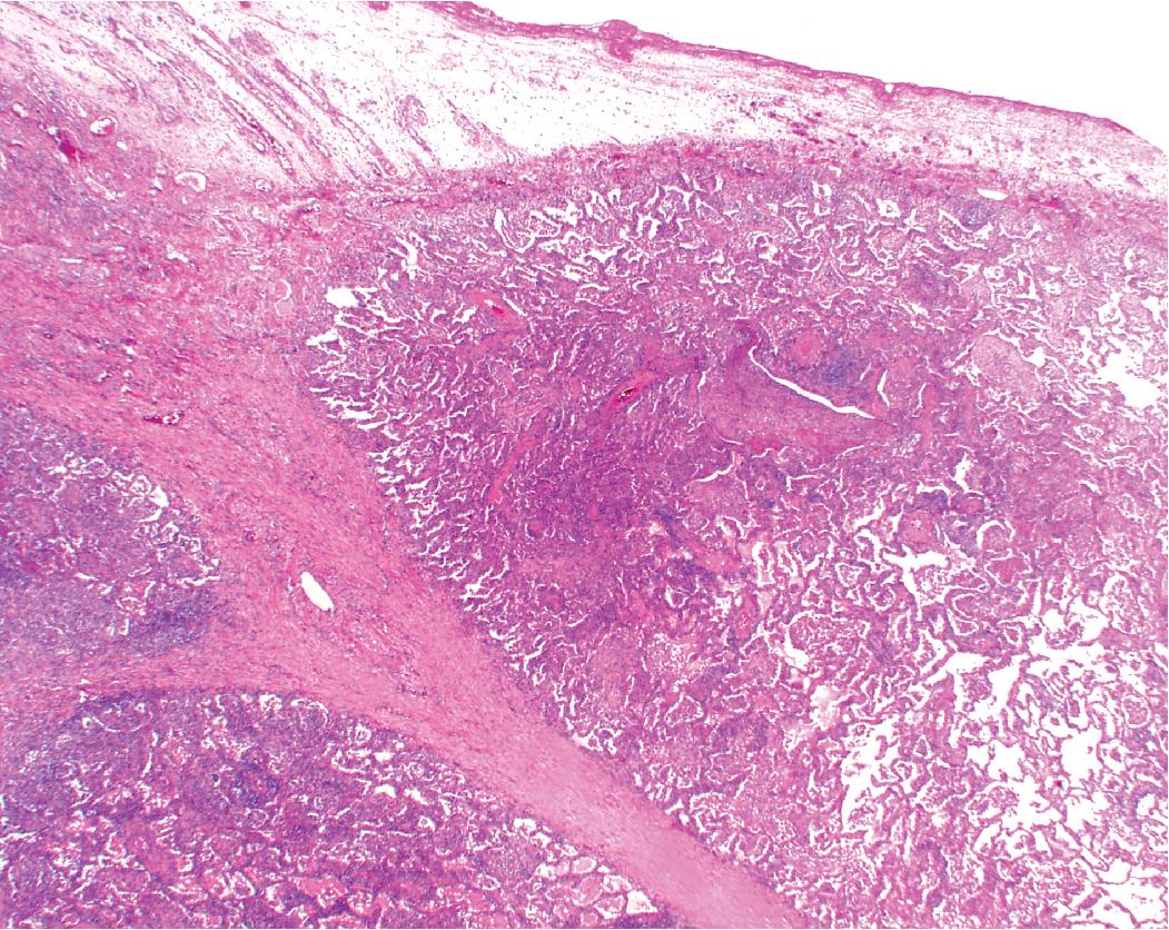 Figure 7.22, Chronic pneumonia with thickened interlobular septum.