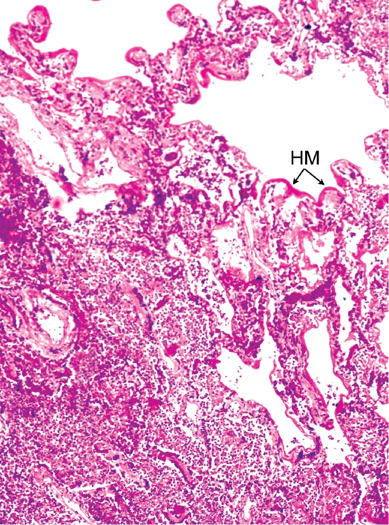 Figure 7.23, Bacterial pneumonia with hyaline membranes (HM) at periphery.