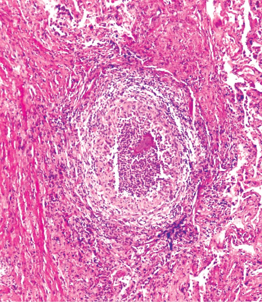 Figure 7.27, Botryomycosis granule with hematoxylinophilic core and eosinophilic investment known as the Splendore-Hoeppli effect .