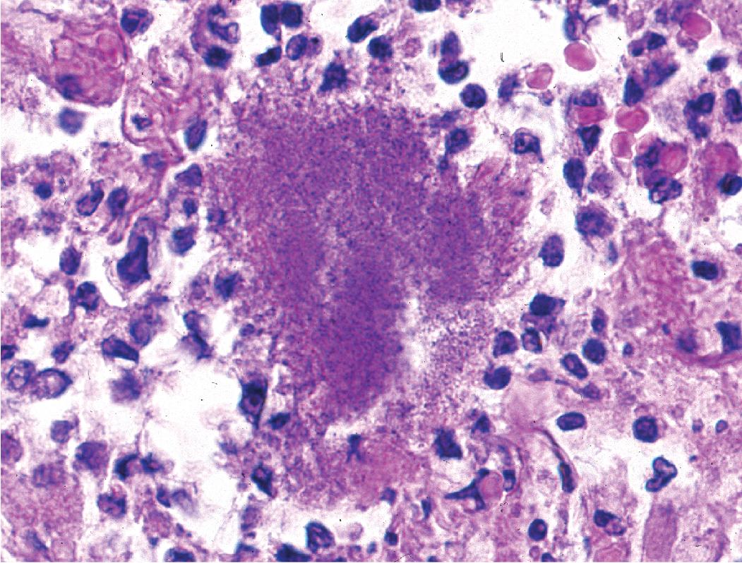 Figure 7.28, Loose-textured aggregate of Nocardia filamentous bacteria surrounded by neutrophils.