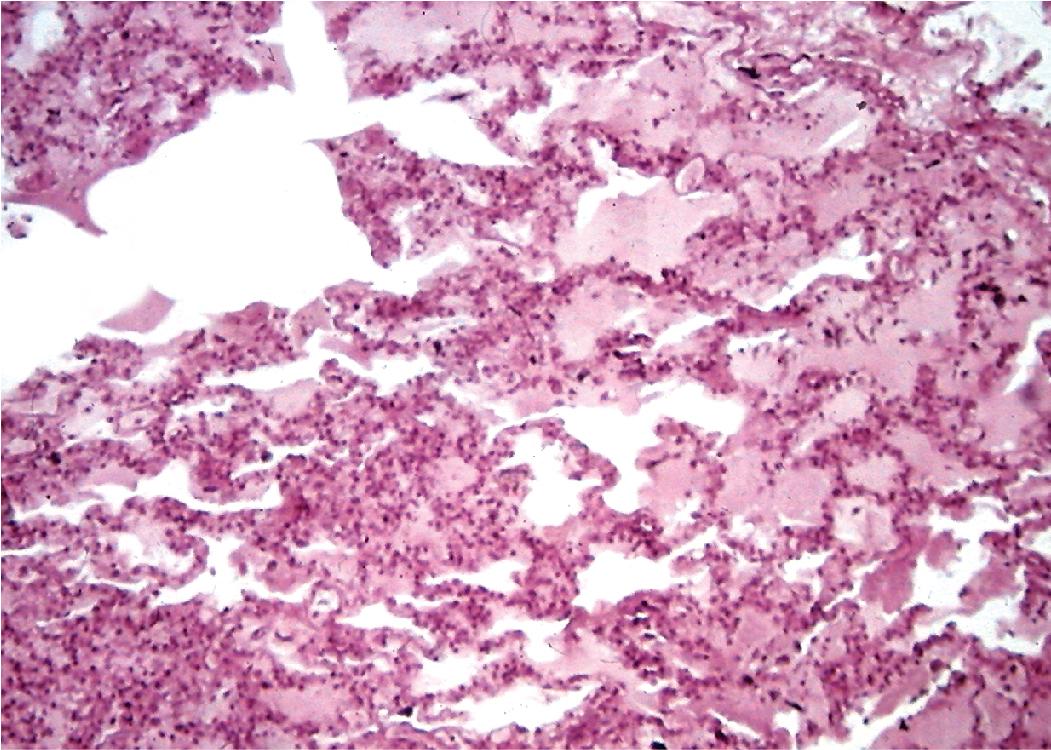 Figure 7.29, Plague pneumonia, early phase. Edema, fibrin, and sparse inflammatory cells are evident.