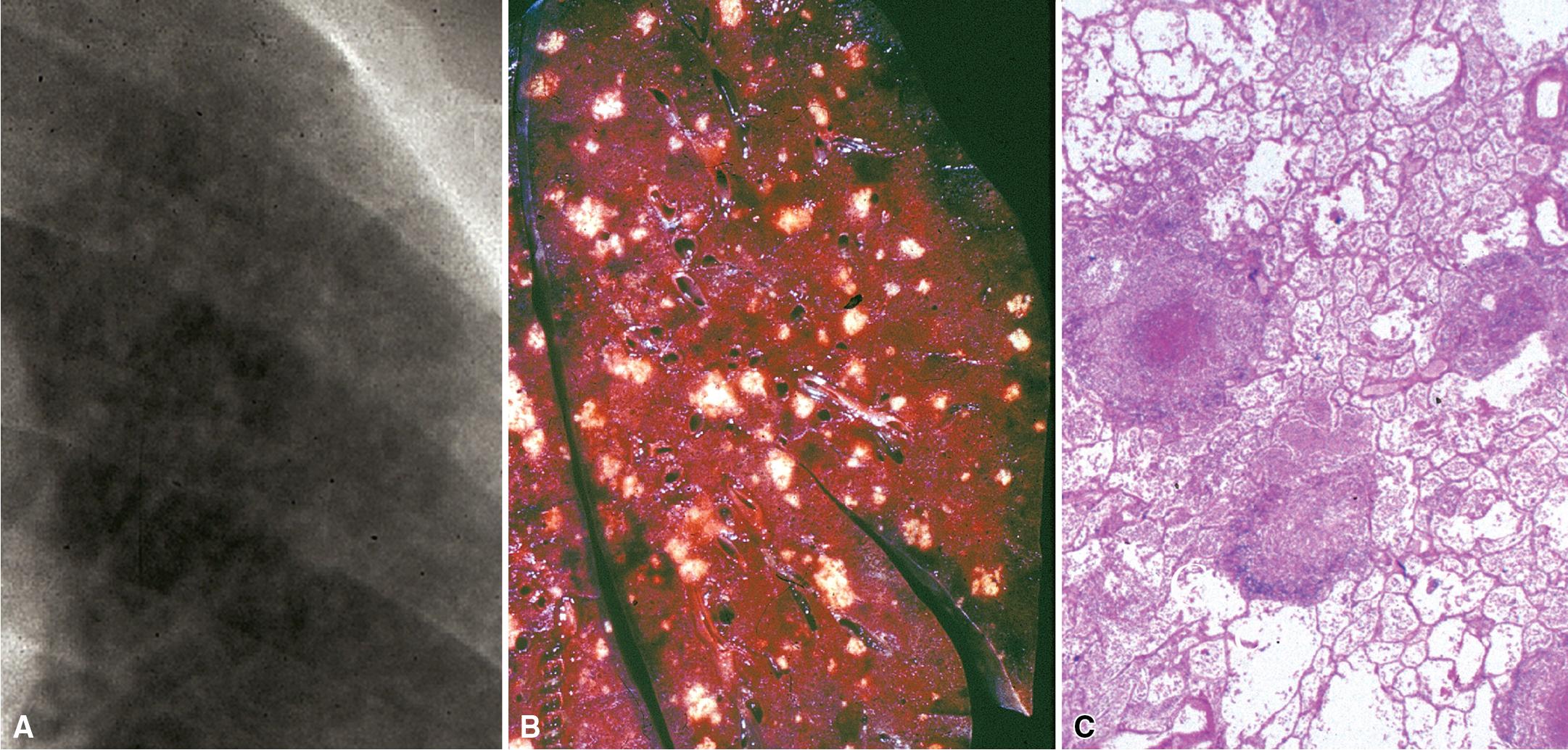 Figure 7.3, Miliary pattern of tuberculosis. (A) Chest film, closeup view of miliary infiltrate. (B) Gross cut surface of pulmonary parenchyma with miliary nodules. (C) Histopathologic features of miliary necrotizing granulomas.