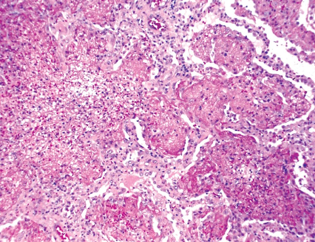 Figure 7.31, Tularemia. Fibrinous lobular pneumonia phase.