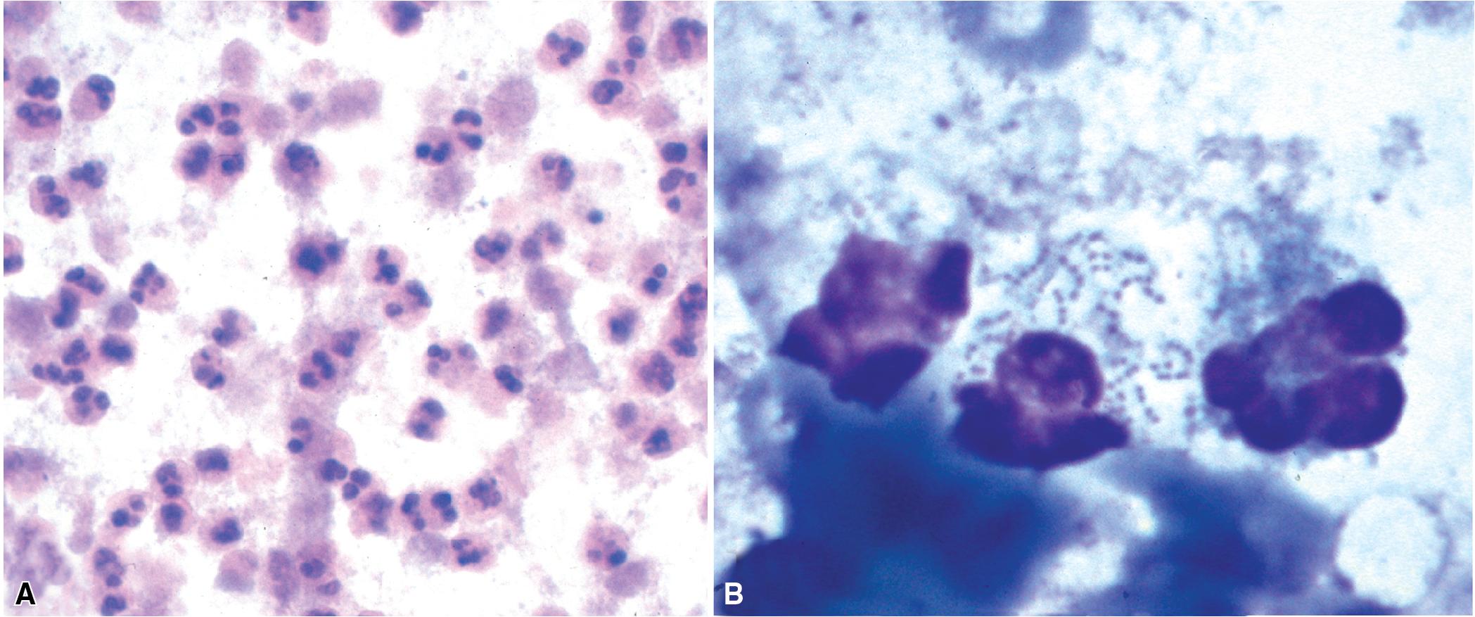 Figure 7.32, (A) Purulent exudate of nodular pulmonary infiltrate in fine-needle aspirate (alcohol-fixed). (B) Streptococci ( viridans group) in cytoplasm of neutrophil seen in fine-needle aspirate (Diff-Quik preparation).