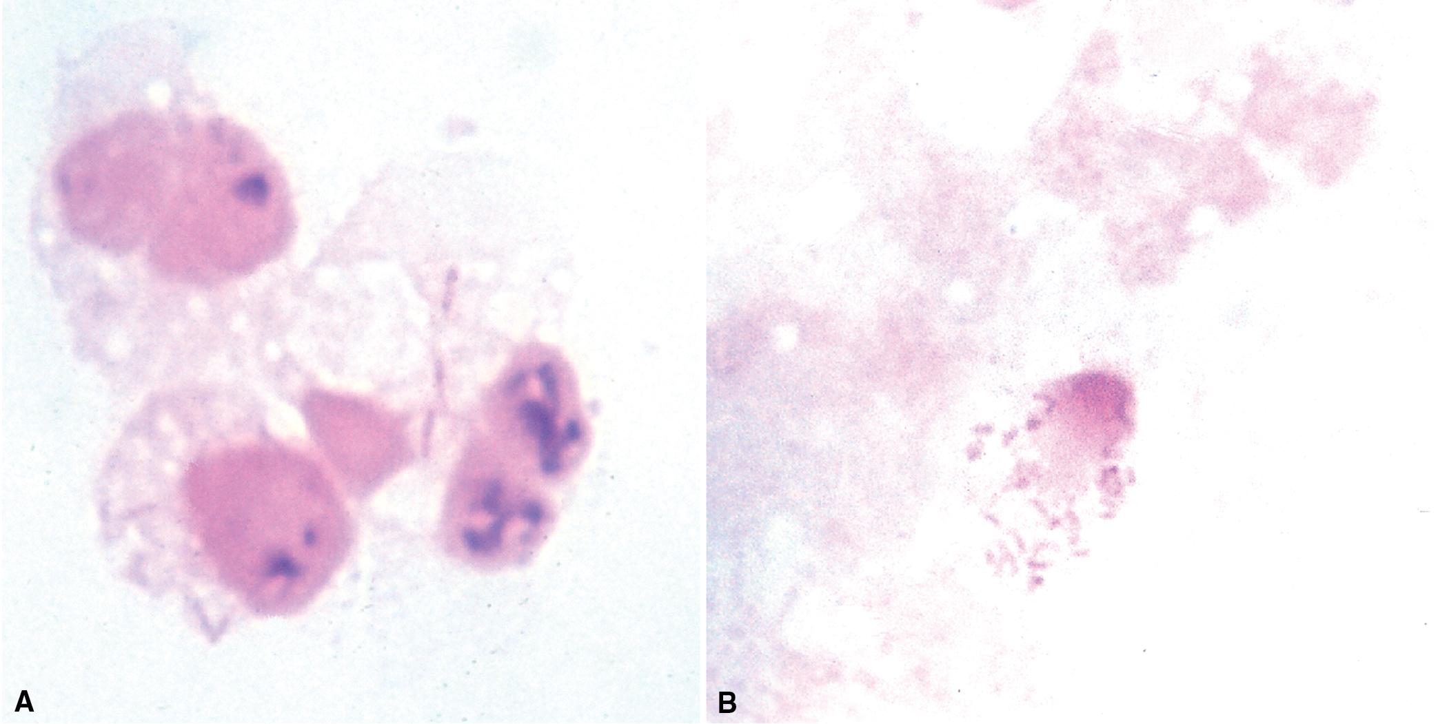 Figure 7.33, (A) Fusiform bacteria ( Fusobacterium organisms) in cytoplasm of neutrophil in fine-needle aspirate (Gram stain). (B) Coccobacilli (Haemophilus influenzae) in cytoplasm of leukocyte in fine-needle aspirate (Gram stain).