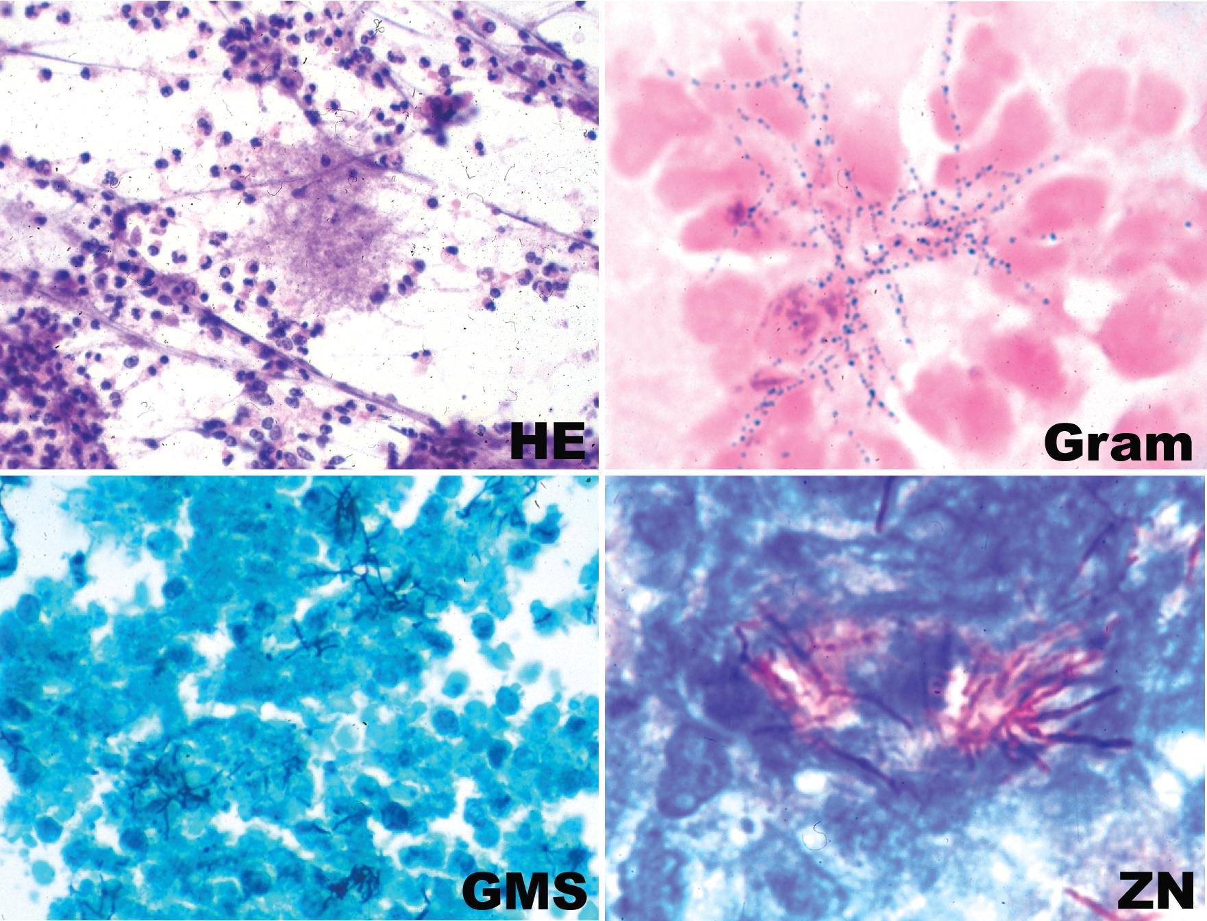 Figure 7.34, Nocardia . Loose, feathery cluster of bacilli in purulent exudate seen in a fine-needle aspirate: alcohol-fixed, Hematoxylin and eosin stain (HE) ; Gram stain (Gram) ; Grocott methenamine silver stain (GMS) ; Ziehl–Neelsen stain (ZN) .