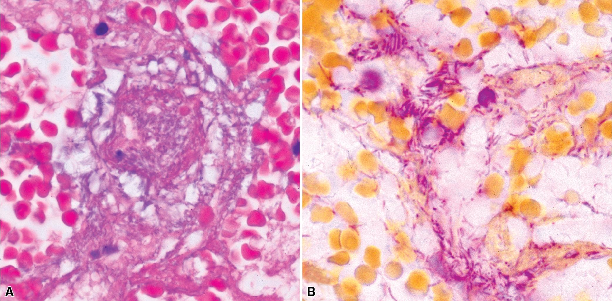 Figure 7.35, (A) Pseudomonas aeruginosa bacilli investing interstitial vessels (Brown and Hopps stain). (B) The slender gram-negative bacilli are nicely demonstrated on Gram stain.