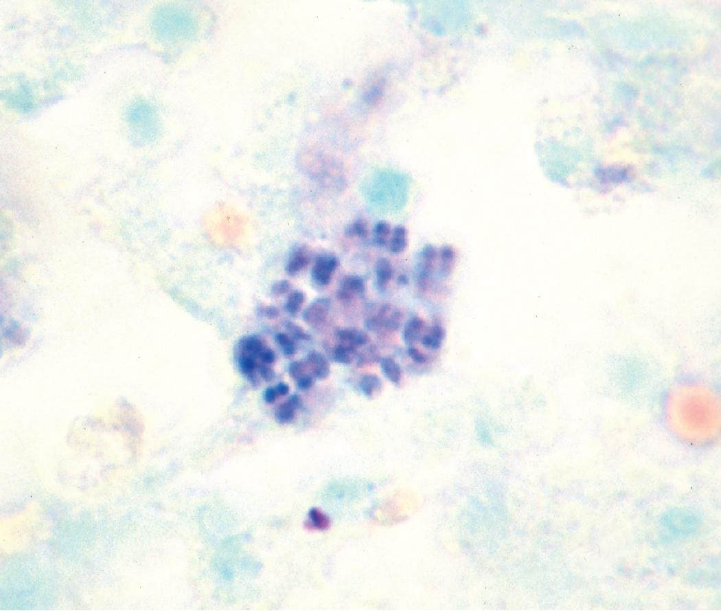 Figure 7.36, Bacterial tetrads in alveolar exudate (Giemsa stain).