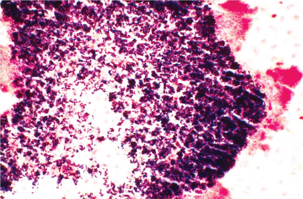 Figure 7.37, Botryomycosis. Cluster of gram-positive cocci (Staphylococcus aureus) invested by gram-negative–staining Splendore-Hoeppli material (Brown and Brenn stain).