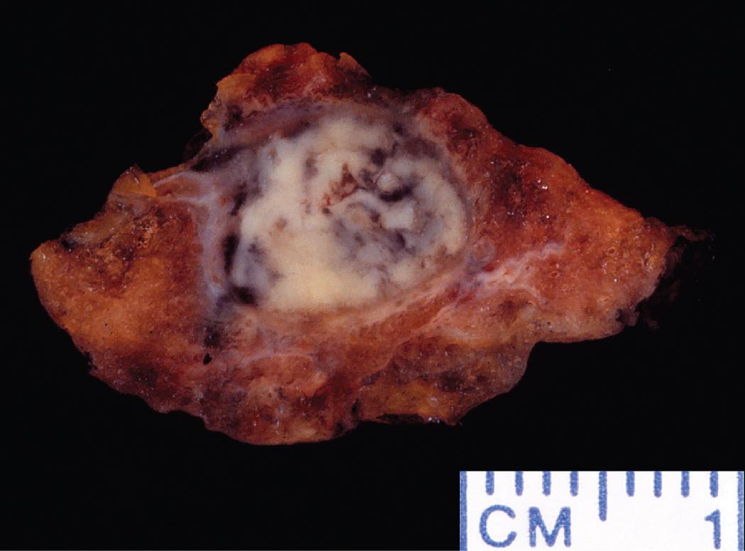 Figure 7.38, Tuberculoma removed from right upper lobe.