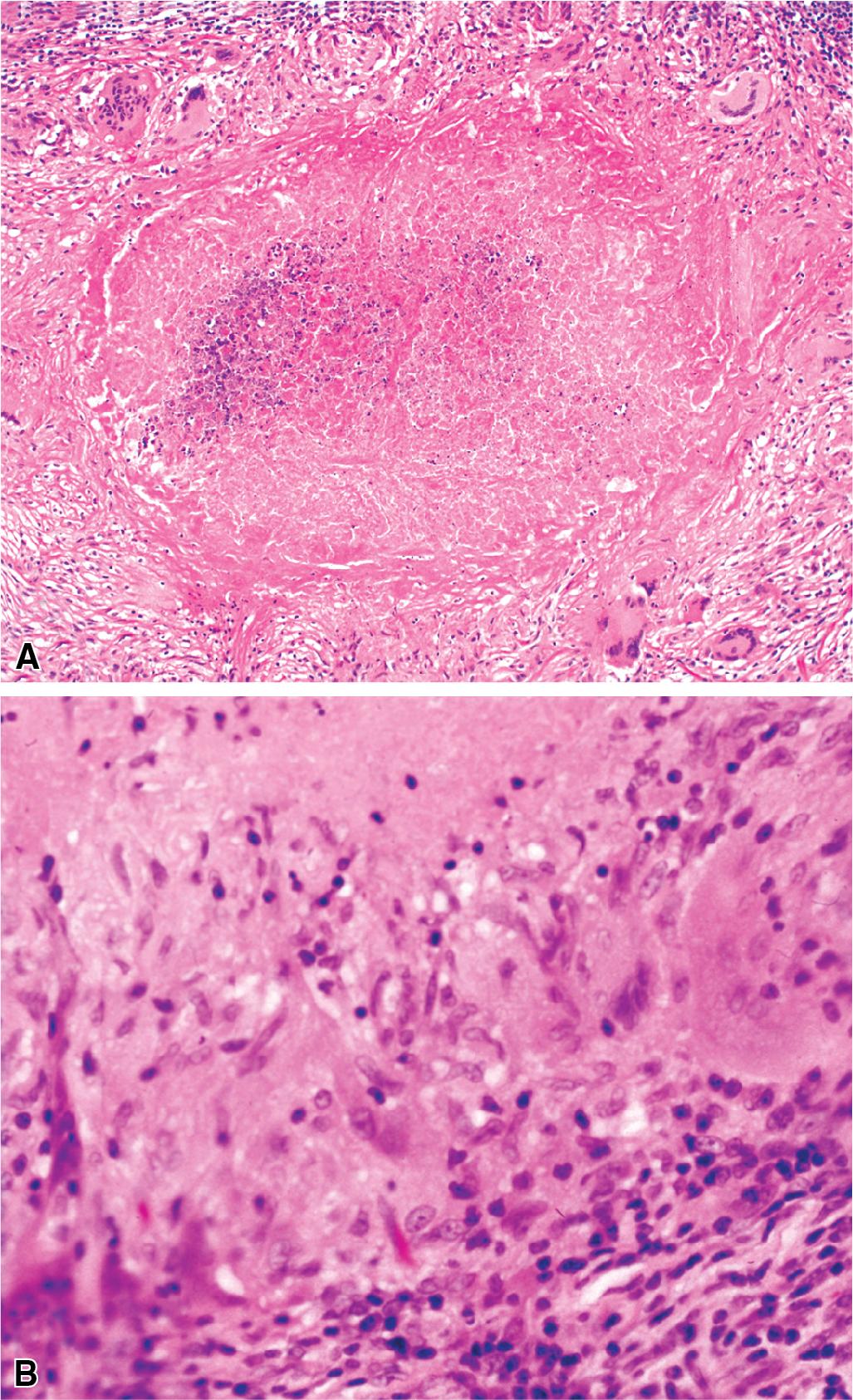 Figure 7.39, (A) Tuberculoid granuloma with central zone of caseation necrosis surrounded by epithelioid cells, giant cells, and outer investment of lymphocytes. (B) Palisade of epithelioid histiocytes in giant cells at edge of necrotic zone.