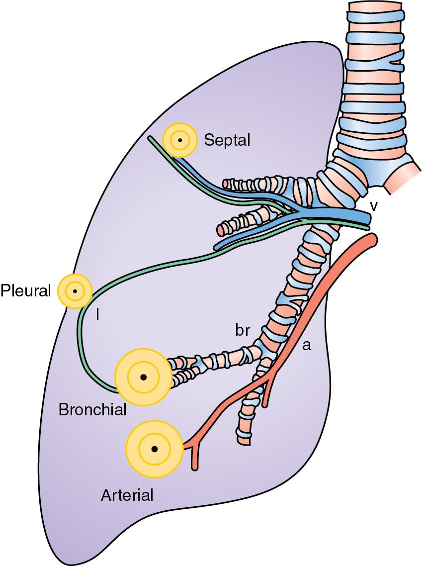 Figure 7.40, Complications of tuberculosis. Invasion of arteries (a) with miliary spread; bronchi (br) with tuberculous bronchopneumonia; lymphatics (l) with granulomatous pleuritis and effusions. Invasion of septal veins (v) leads to extrapulmonary dissemination.