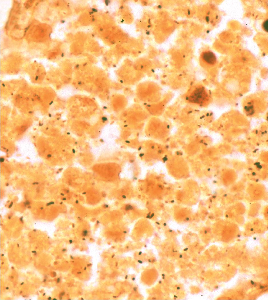 Figure 7.4, Black (silver-coated) bacilli (Legionella pneumophila) in alveolar exudate (Dieterle stain).