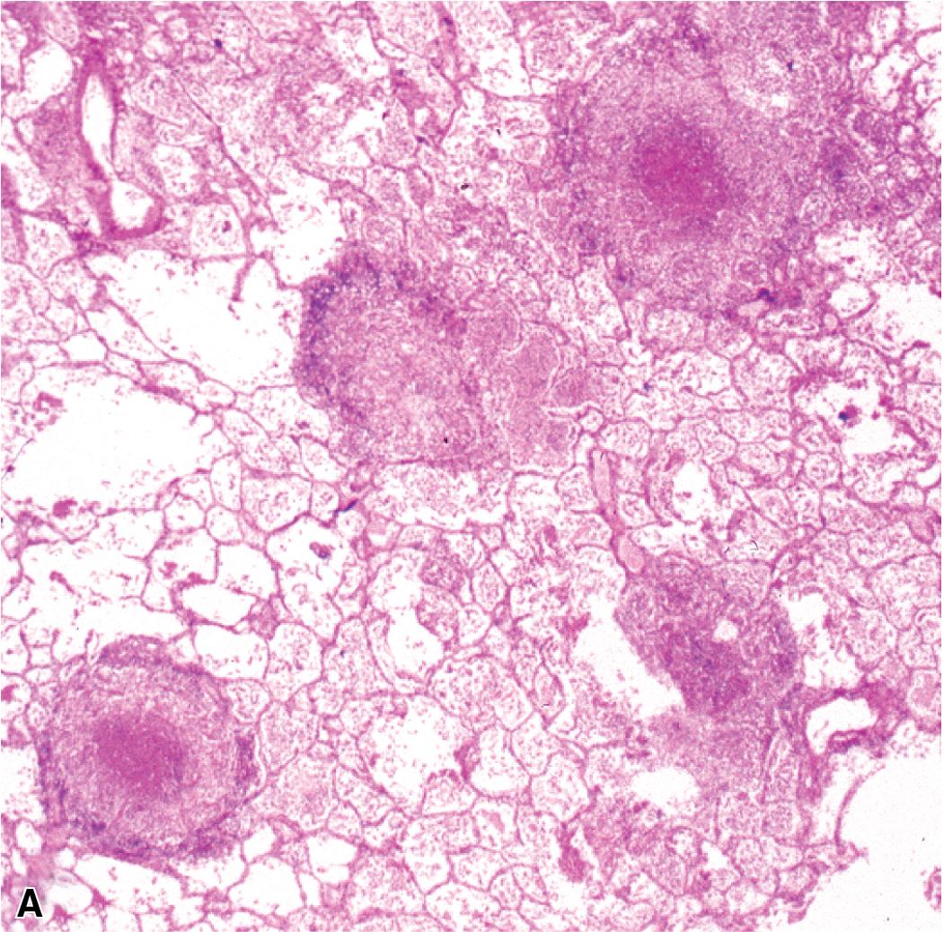 Figure 7.41, Miliary tuberculosis. (A) Miliary pattern. (B) Epithelioid granulomas with necrotic central zones.