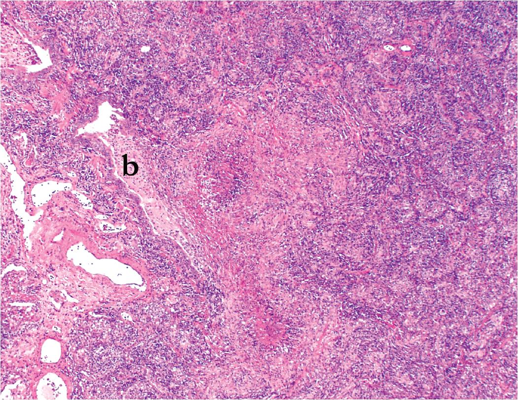 Figure 7.42, Bronchocentric granuloma in mycobacterial infection. Only a small focus of residual bronchial epithelium (b) remains.