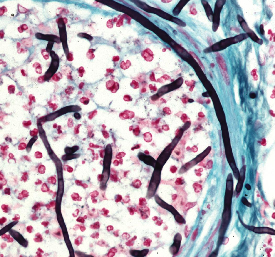 Figure 7.6, Angioinvasive Aspergillus species (Grocott methenamine silver stain).