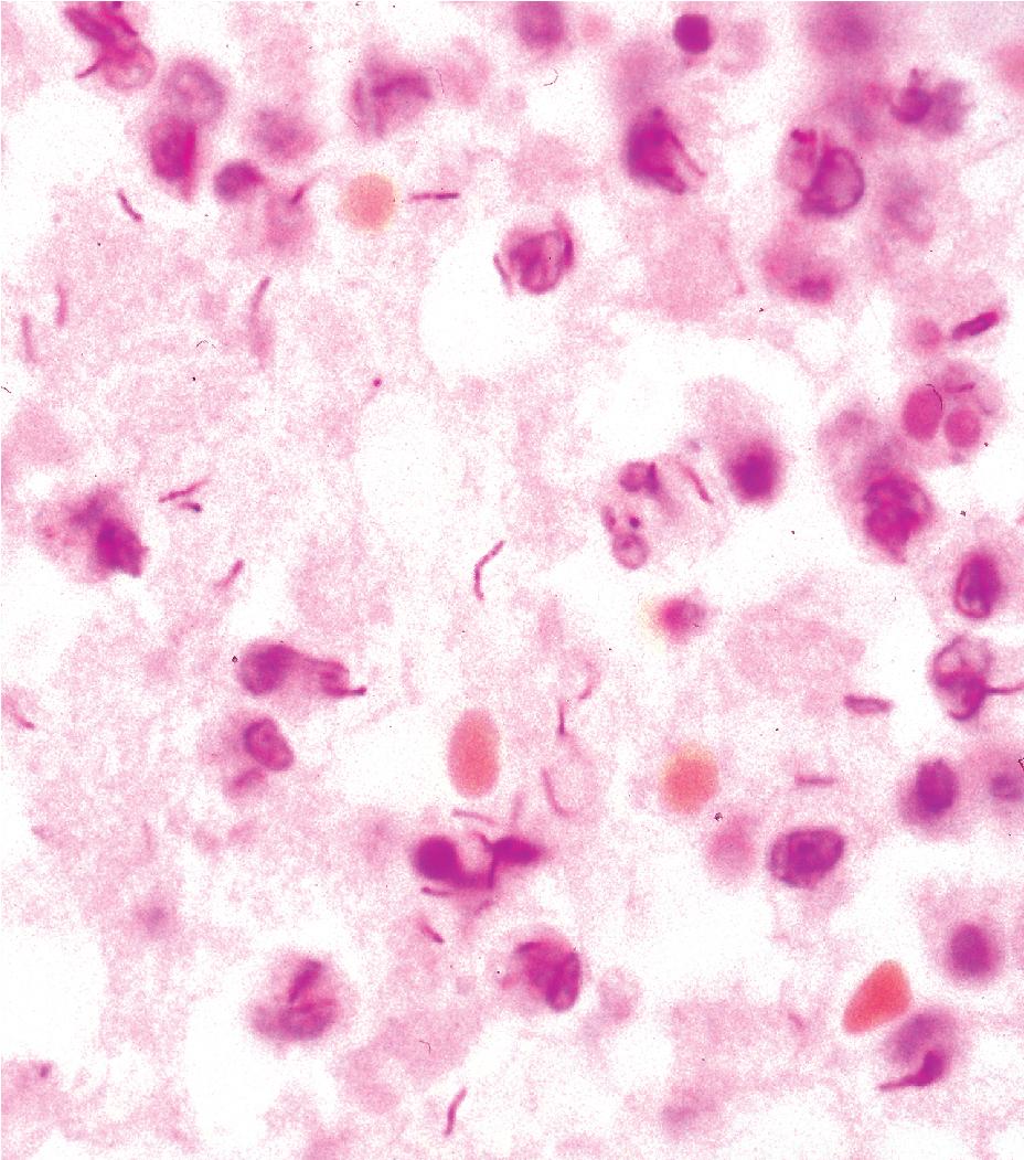 Figure 7.7, Acid-fast bacilli: Mycobacterium tuberculosis (Ziehl–Neelsen stain).